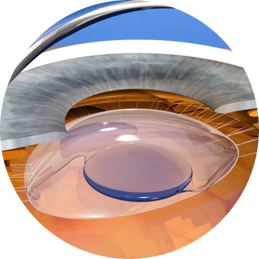 A Taste of ASCRS 2023 ASCRS